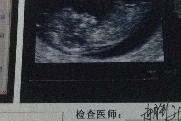 ���к��ӵ�֢״����Щ ������Բ�Ļ��Ǽ��