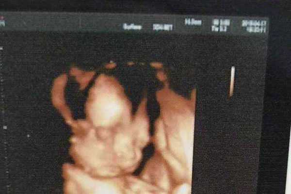 ���к��ӵ�֢״����Щ ������Բ�Ļ��Ǽ��