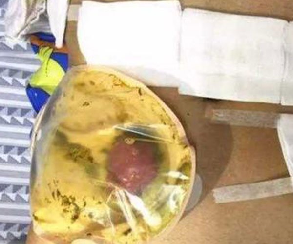 人工肛门有多痛苦 肉体上的痛苦又算的了什么