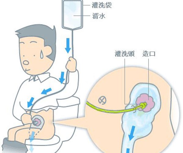 换人工肛门后自己怎么处理 要经常更换便袋不方便
