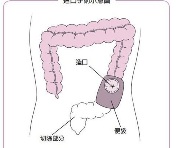 换人工肛门后自己怎么处理 要经常更换便袋不方便