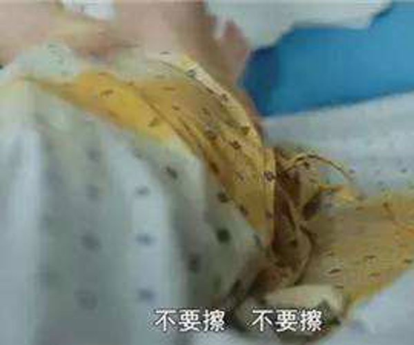 换人工肛门后自己怎么处理 要经常更换便袋不方便