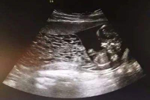 ����̥�ǰ�֢�� �������ֲ�����û�������Ŀ���