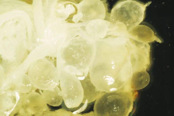 葡萄胎生下宝宝的图片 无法诞生胎死腹中不被允许