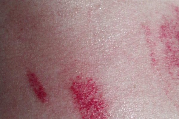 ������ݮ��ʲô���� ���˱�����ݮ�������ô����