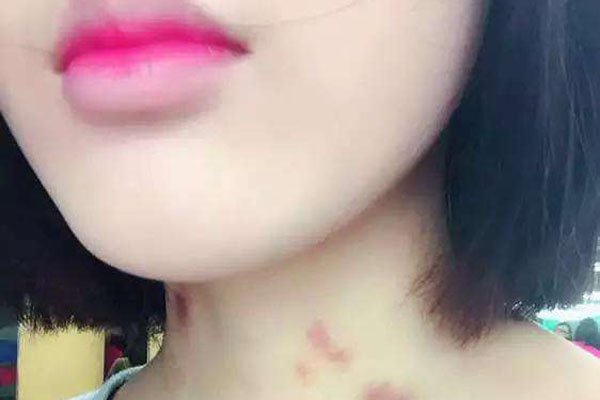 ������ݮ��ʲô���� ���˱�����ݮ�������ô����