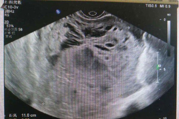 ����̥��ʲô ��ɱ��̥����ô��ô����