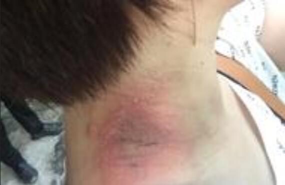 �������ҧ�˺�����Щ֢״�أ���ҧ�˺�����������