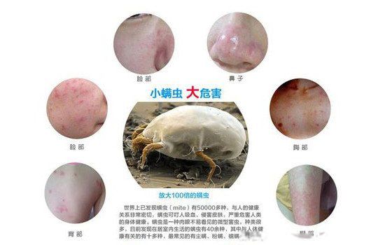 床上有螨虫的表现是什么样的有螨虫怎么去除小妙招