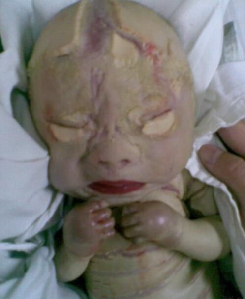 火棉胶婴儿是什么原因造成的 罕见的遗传病真实图片