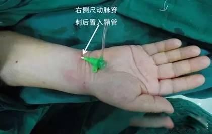 dsa医学上是什么意思心脏dsa造影是什么检查