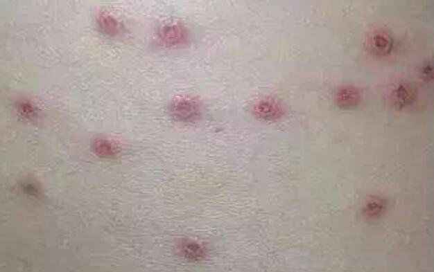 水痘是什么症状图片