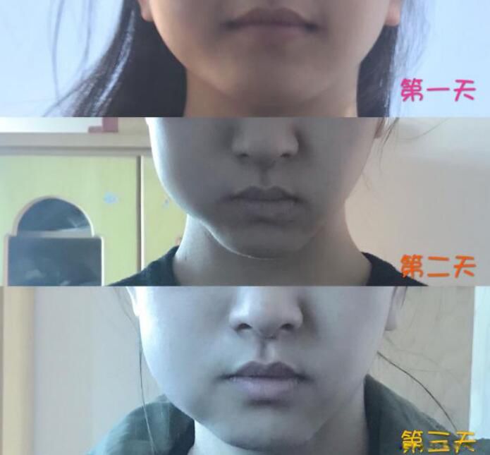 拔了智齿要注意些什么 为什么很多人都说拔智齿后悔死了