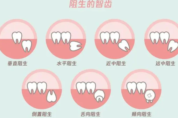 智齿一定要拔掉吗 为什么牙医建议尽量不拔智齿