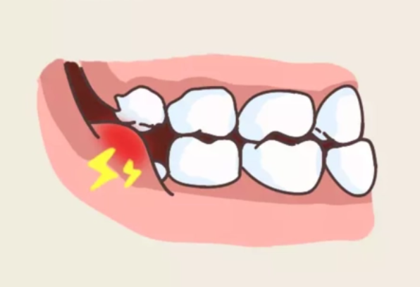 智齿一定要拔掉吗 为什么牙医建议尽量不拔智齿