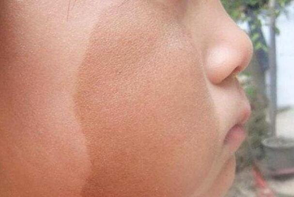 ��ɫ̥����ʲôԭ������� ��ɫ̥�ǵĴ�˵Ԣ����ʲô