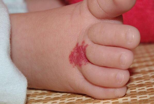 ��ɫ̥����ʲôԭ������� ��ɫ̥�ǵĴ�˵Ԣ����ʲô