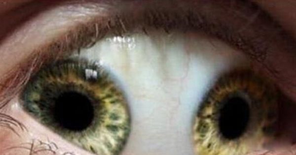 ˫ͫ�׵��˳�ʲô�� ��ʵ��˫ͫ����Ĵ�����