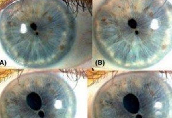 ˫ͫ�׵��˳�ʲô�� ��ʵ��˫ͫ����Ĵ�����