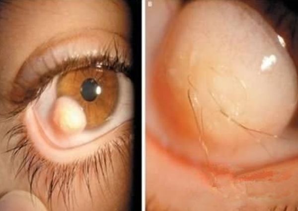 ˫ͫ�׵��˳�ʲô�� ��ʵ��˫ͫ����Ĵ�����