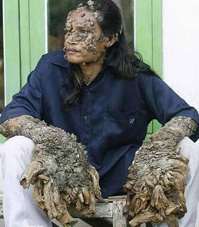 很多年前,印度尼西亚一名男子因为四肢和脸上长出像树根一样的肉瘤,而