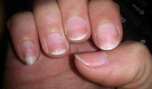 林赛氏指甲图片和症状 林赛氏指甲是病吗