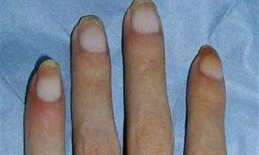 林赛氏指甲图片和症状 林赛氏指甲是病吗