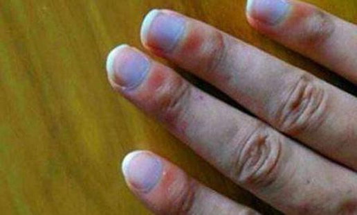 林赛氏指甲图片和症状 林赛氏指甲是病吗