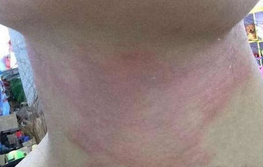 隐翅虫是什么虫毒性大吗 隐翅虫咬人后症状早期