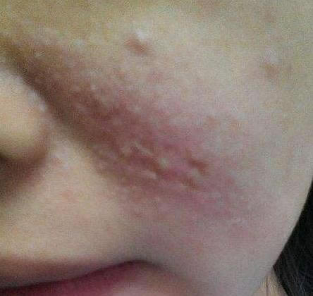 隐翅虫是什么虫毒性大吗 隐翅虫咬人后症状早期