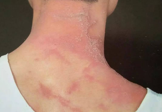 隐翅虫是什么虫毒性大吗 隐翅虫咬人后症状早期