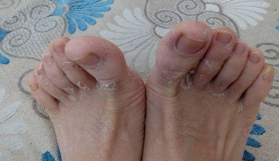 脚气刚开始的症状表现 脚气三种类型图片