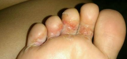 �����տ�ʼ��֢״���� ������������ͼƬ