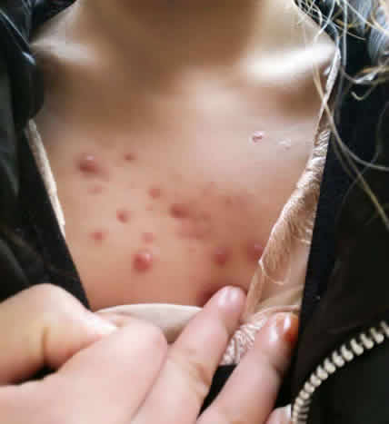 ÷��������֢״ͼƬ ÷������С�����ͼƬ