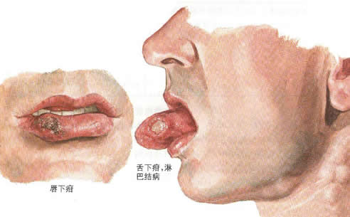 ÷��������֢״ͼƬ ÷������С�����ͼƬ