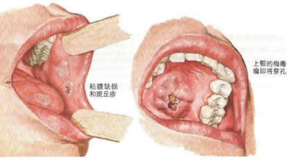 ÷��������֢״ͼƬ ÷������С�����ͼƬ