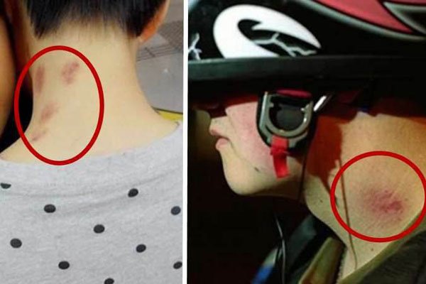 吸草莓之后难受 被吸完草莓后女生是什么感觉