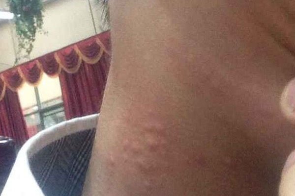 吸草莓之后难受 被吸完草莓后女生是什么感觉