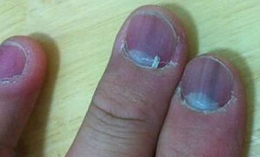 ָ�׷�����ʲôԭ��? ��ָ�׷���ͼƬ����