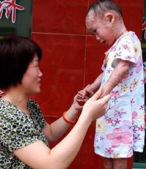 如懿传火棉胶婴儿能治好吗 火棉胶婴儿长大后图片