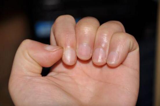 ����ָ�׺��ߴ�����֢ ���������еĺ��߶��ǰ�֢