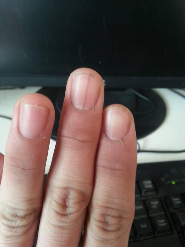 ����ָ�׺��ߴ�����֢ ���������еĺ��߶��ǰ�֢