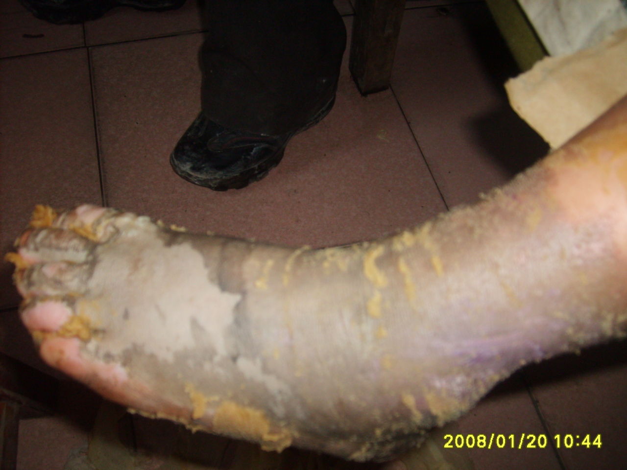 selina烧伤疤痕腿上照片 selina还能不能生小孩