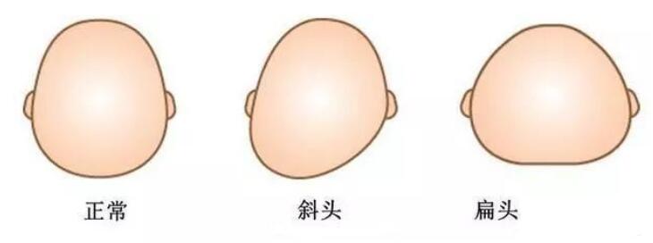 扁头是睡出来的还是天生的 扁头的人侧面长得好丑
