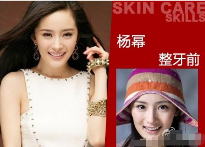 杨幂下牙只有6颗一笑没有后槽牙真假 是为了脸型拔牙了吗