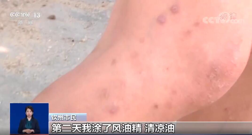 �����ҧ�˺�����ͼƬ �������ҧ����ʲô֢״ ��ô����