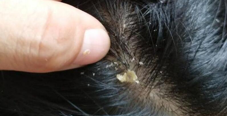 ���涣ҧ���֢״ͼ ����ΪʲôֻҪ���Ӳ�ҧ����