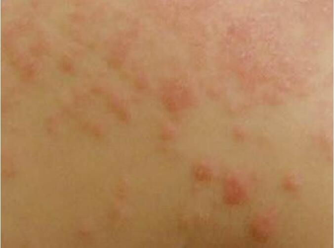 ���涣ҧ���֢״ͼ ����ΪʲôֻҪ���Ӳ�ҧ����