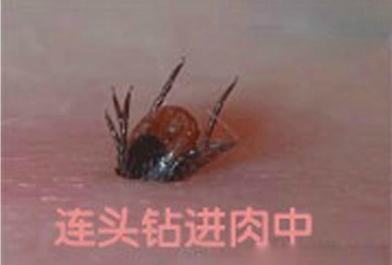 ��涣ҧ��֢״ͼƬ ���ҧ��ʲô֢״