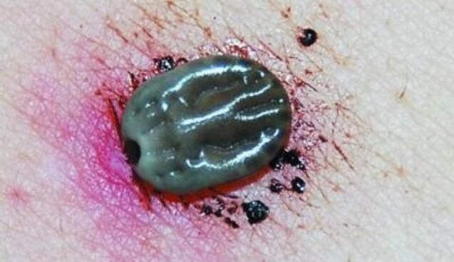 蜱虫叮咬后症状图片 蜱虫咬了什么症状